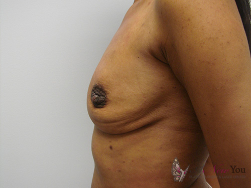 Breast Augmentation Before - Chicago, IL