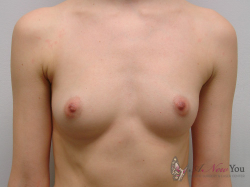 Breast Augmentation Before - Chicago, IL