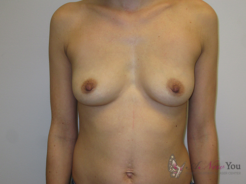 Breast Augmentation Before - Chicago, IL