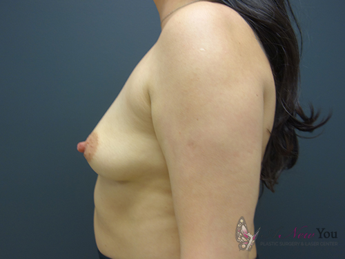 Breast Augmentation Before - Chicago, IL