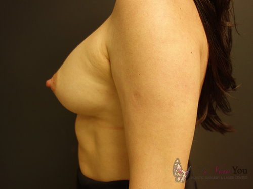 Breast Augmentation After - Chicago, IL