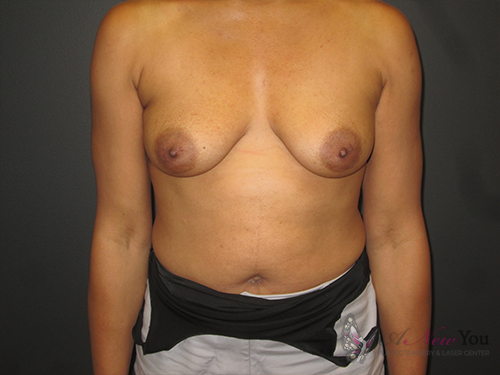 Breast Augmentation Before - Chicago, IL