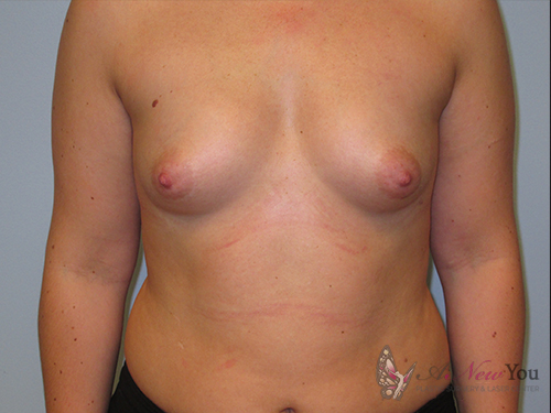 Breast Augmentation Before - Chicago, IL