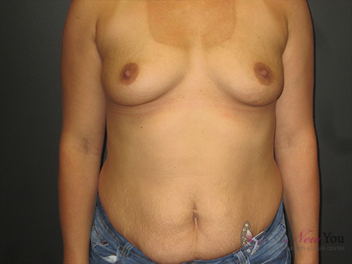 Breast Augmentation Before - Chicago, IL