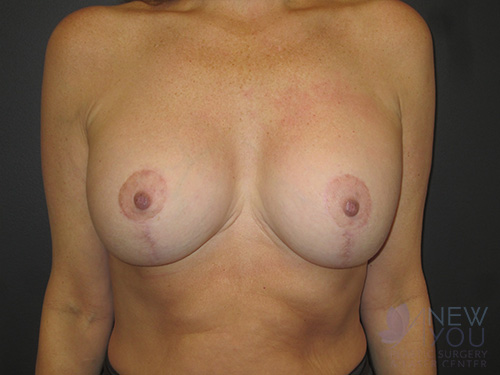 Breast Augmentation After Breast Augmentation After - Chicago, IL