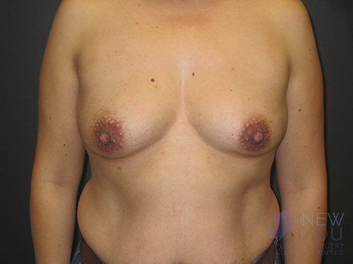 Breast Augmentation Before - Chicago, IL