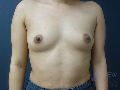 Breast Augmentation Before - Chicago, IL