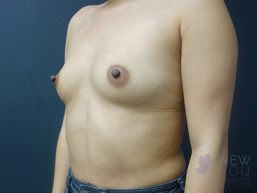 Breast Augmentation Before - Chicago, IL