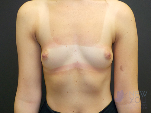 Breast Augmentation Before - Chicago, IL