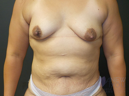 Breast Augmentation Before - Chicago, IL