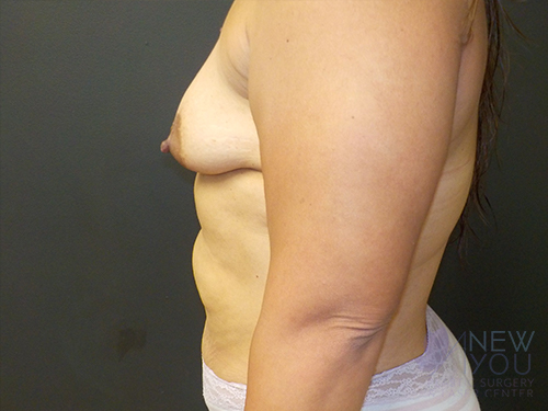 Breast Augmentation Before - Chicago, IL