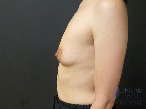 Breast Augmentation Before - Chicago, IL