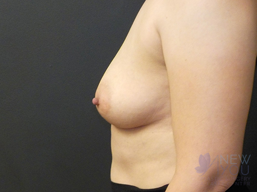 Breast Augmentation Before - Chicago, IL