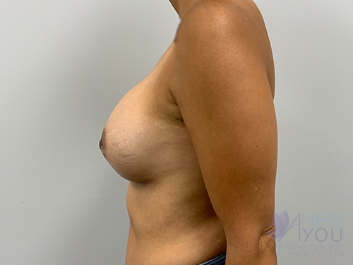 Breast Augmentation After - Chicago, IL