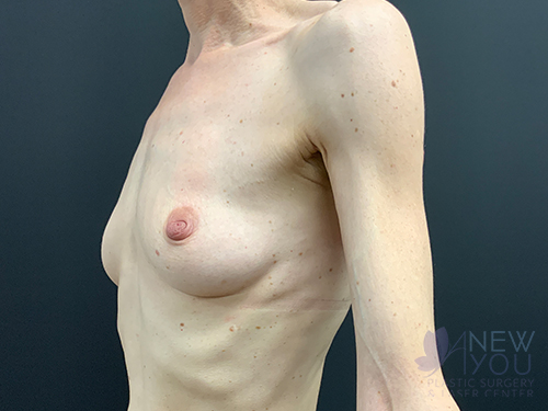 Breast Augmentation Before - Chicago, IL