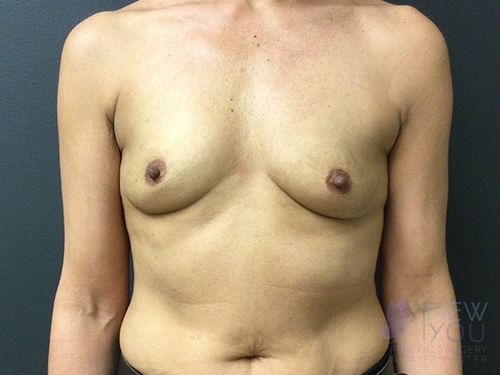 Breast Augmentation Before - Chicago, IL