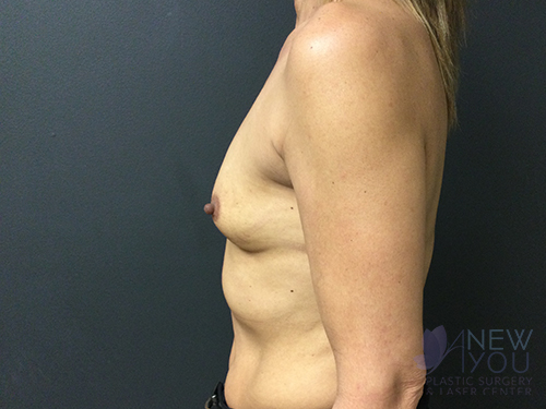 Breast Augmentation Before - Chicago, IL