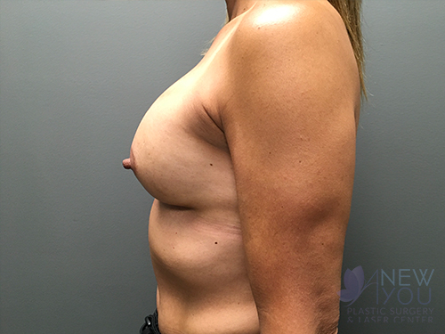 Breast Augmentation After - Chicago, IL