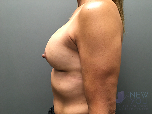 Breast Augmentation After Breast Augmentation After - Chicago, IL
