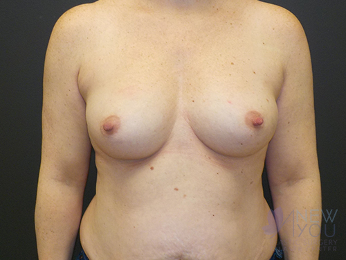 Breast Augmentation Before - Chicago, IL