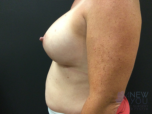 Breast Augmentation After - Chicago, IL