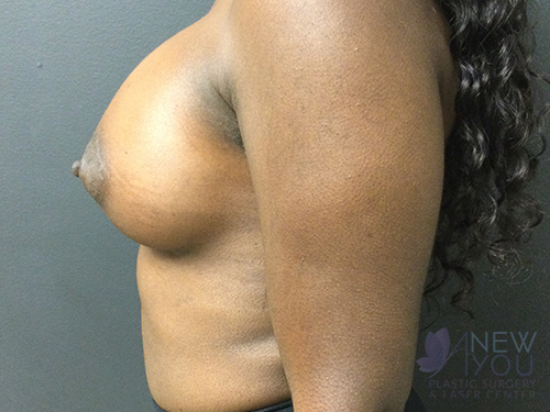 Breast Augmentation After - Chicago, IL