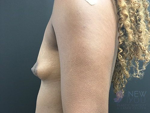 Breast Augmentation Before - Chicago, IL