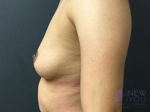 Breast Augmentation Before - Chicago, IL