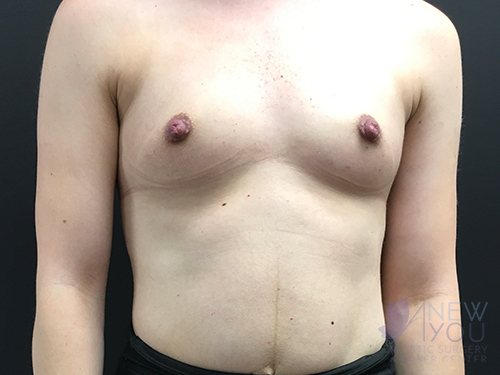 Breast Augmentation Before - Chicago, IL