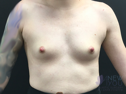 Breast Augmentation Before - Chicago, IL