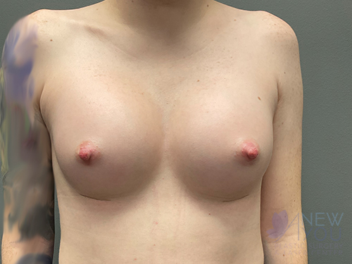 Breast Augmentation After - Chicago, IL