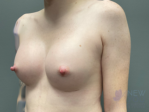 Breast Augmentation After - Chicago, IL