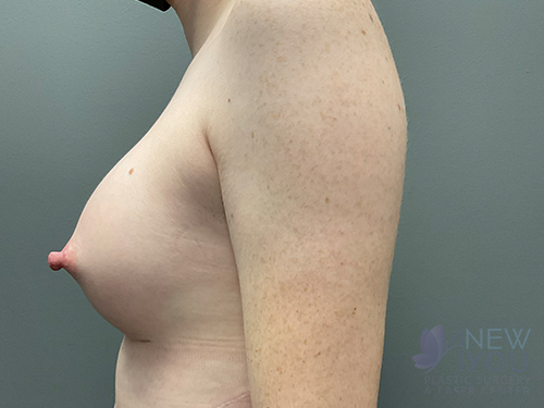 Breast Augmentation After - Chicago, IL