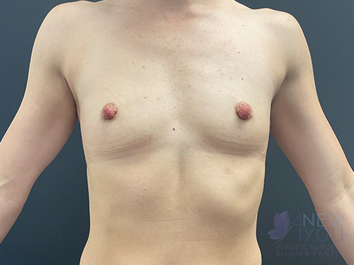 Breast Augmentation Before - Chicago, IL