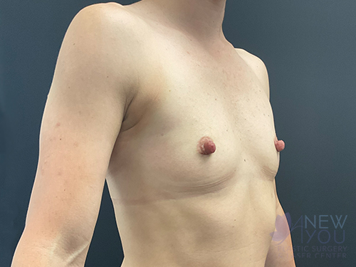 Breast Augmentation Before - Chicago, IL