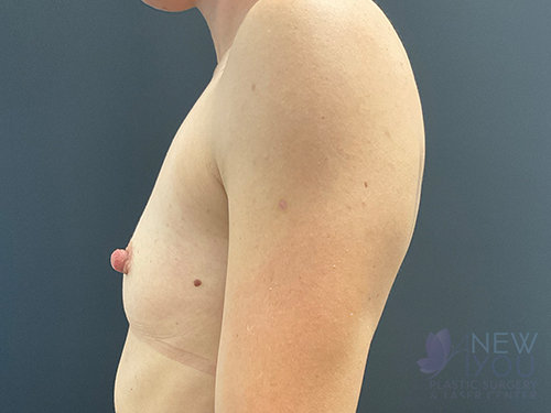 Breast Augmentation Before - Chicago, IL