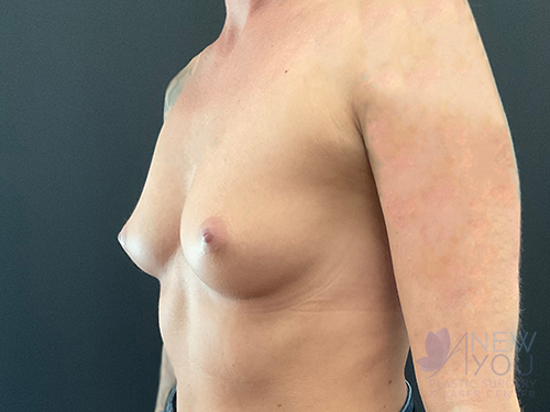 Breast Augmentation Before - Chicago, IL