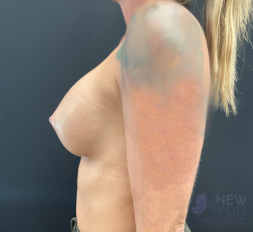 Breast Augmentation After - Chicago, IL