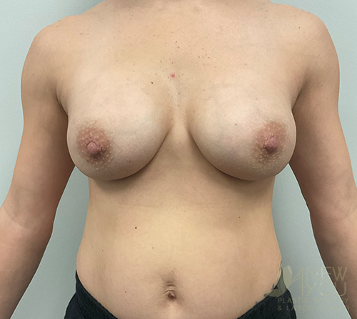 Breast Augmentation After - Chicago, IL