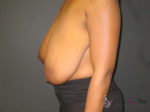 Breast Lift Before - Chicago, IL