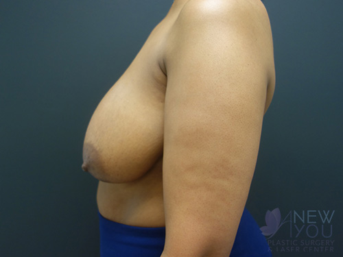 Breast Lift Before - Chicago, IL