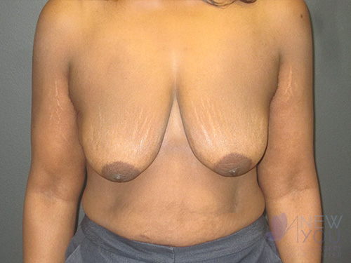 Breast Lift Before - Chicago, IL