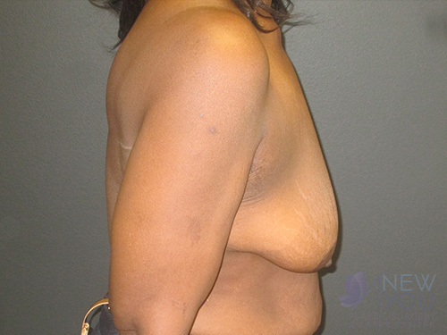 Breast Lift Before Breast Lift Before - Chicago, IL
