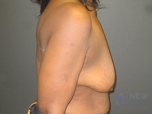 Breast Lift Before - Chicago, IL