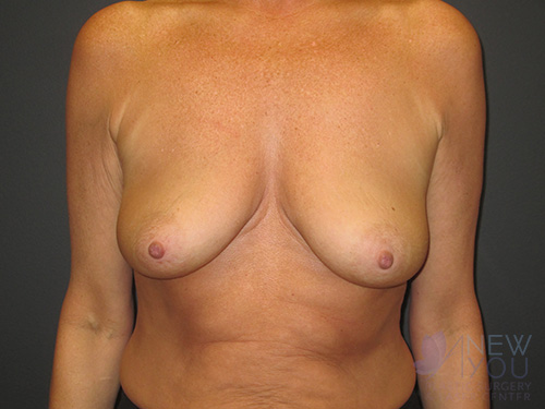 Breast Lift Before - Chicago, IL