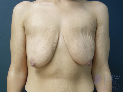 Breast Lift Before - Chicago, IL