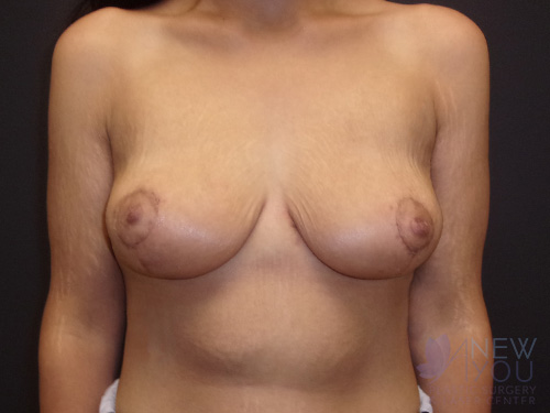 Breast Lift After - Chicago, IL