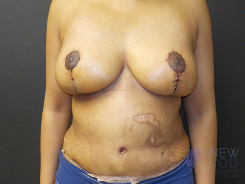 Breast Lift After - Chicago, IL