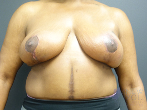 Breast Lift After - Chicago, IL
