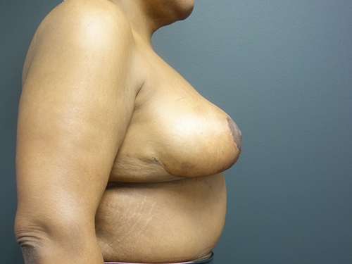 Breast Lift After Breast Lift After - Chicago, IL